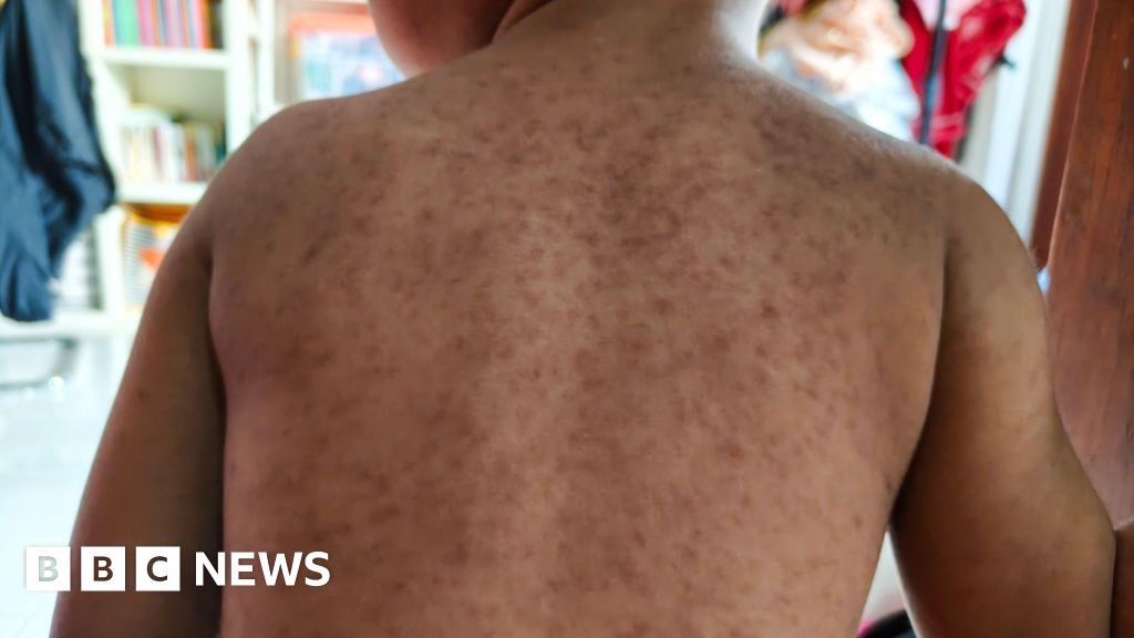 Measles outbreak could see unvaccinated pupils excluded from schools in north London