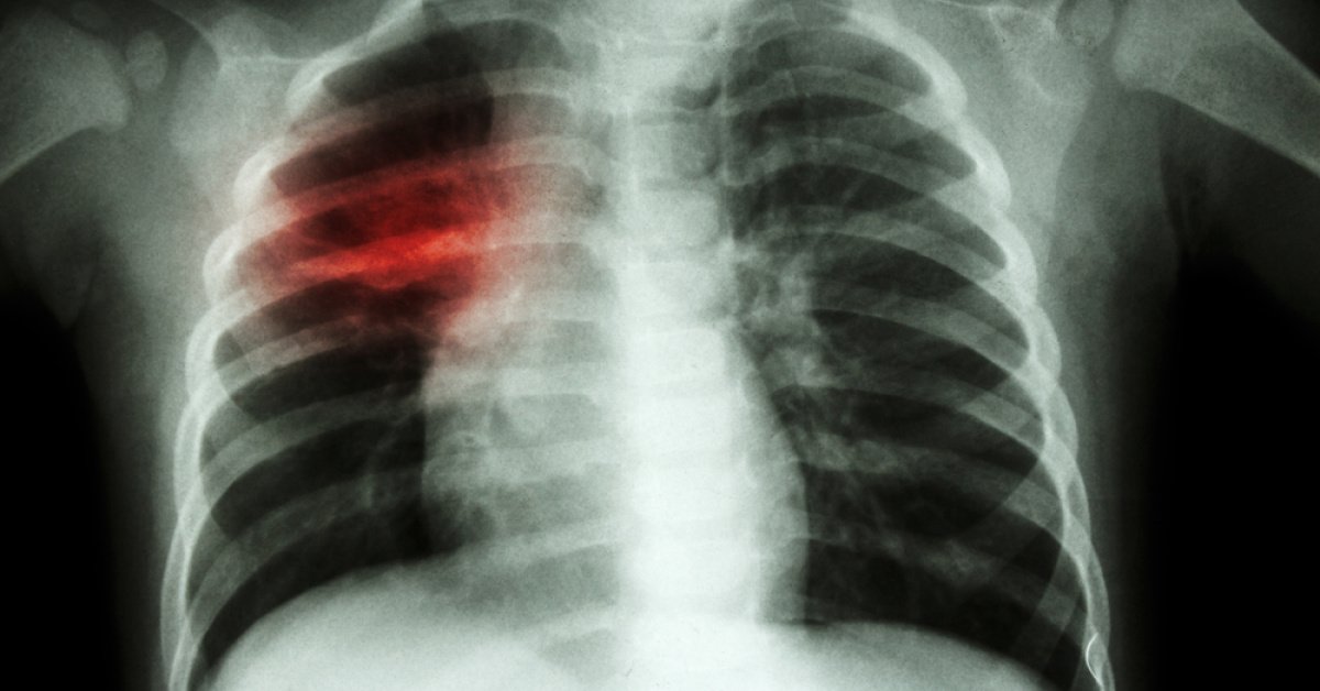 “Griptir geçer” demeyin! Zatürre tehlikesi…