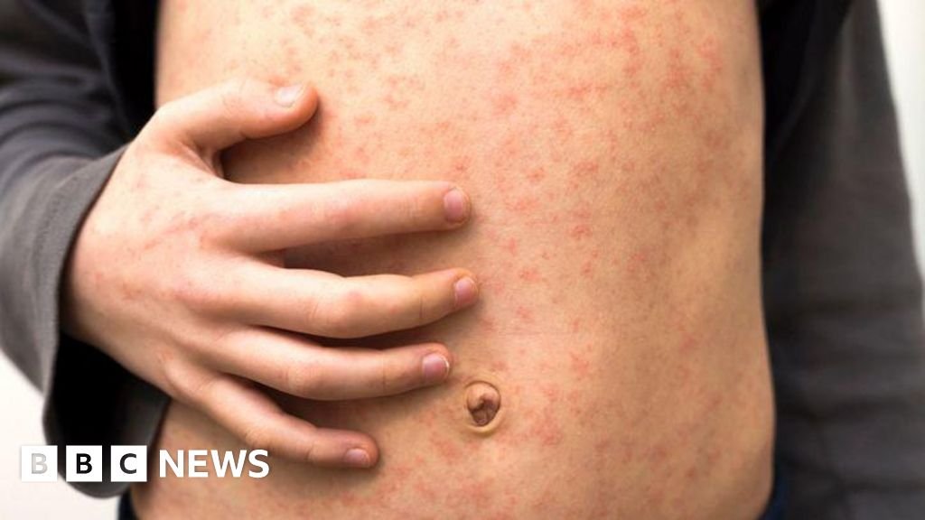 'Fast-spreading' measles outbreak hits several schools in London